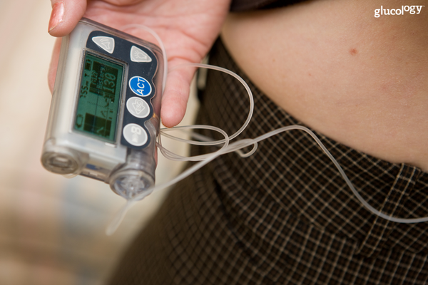Automated Insulin Systems: Medtronic, Tandem, and Omnipod—Which is Best For You ?